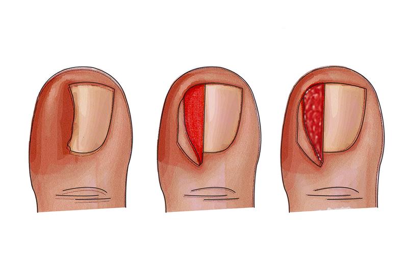 Przebieg zabiegu usuwania paznokcia