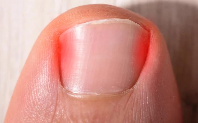 Rekonwalescencja po usunięciu paznokcia