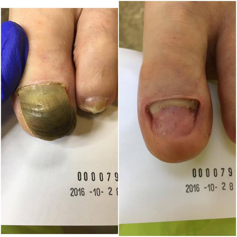 Czy usuwanie paznokcia boli? Odkryj, czego się spodziewać podczas zabiegu